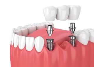 Madhubala Dental Clinic,best dental clinic in tirupattur,best dentist in tirupattur,best Root canal treatment in tirupattur,best Laser treatment in tirupattur,best invisalign treatment in tirupattur,dentist near me tirupattur,madhubala dental hospital tirupattur,madhubala dental clinic tirupattur.