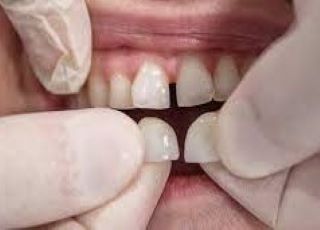 Madhubala Dental Clinic,best dental clinic in tirupattur,best dentist in tirupattur,best Root canal treatment in tirupattur,best Laser treatment in tirupattur,best invisalign treatment in tirupattur,dentist near me tirupattur,madhubala dental hospital tirupattur,madhubala dental clinic tirupattur.